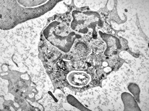M,2w. | bacteriaemia - phagocytosed microbes